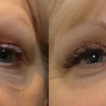 morpheus8-before-after-dr-b-forley-preview-1