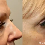 morpheus8-before-after-dr-b-forley-preview-2