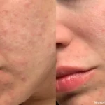 morpheus8-before-after-dr-g-ellis-preview-1