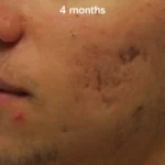 morpheus8-before-after-dr-j-hellman-preview-5-scaled