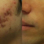 morpheus8-before-after-dr-j-hellman-preview-7