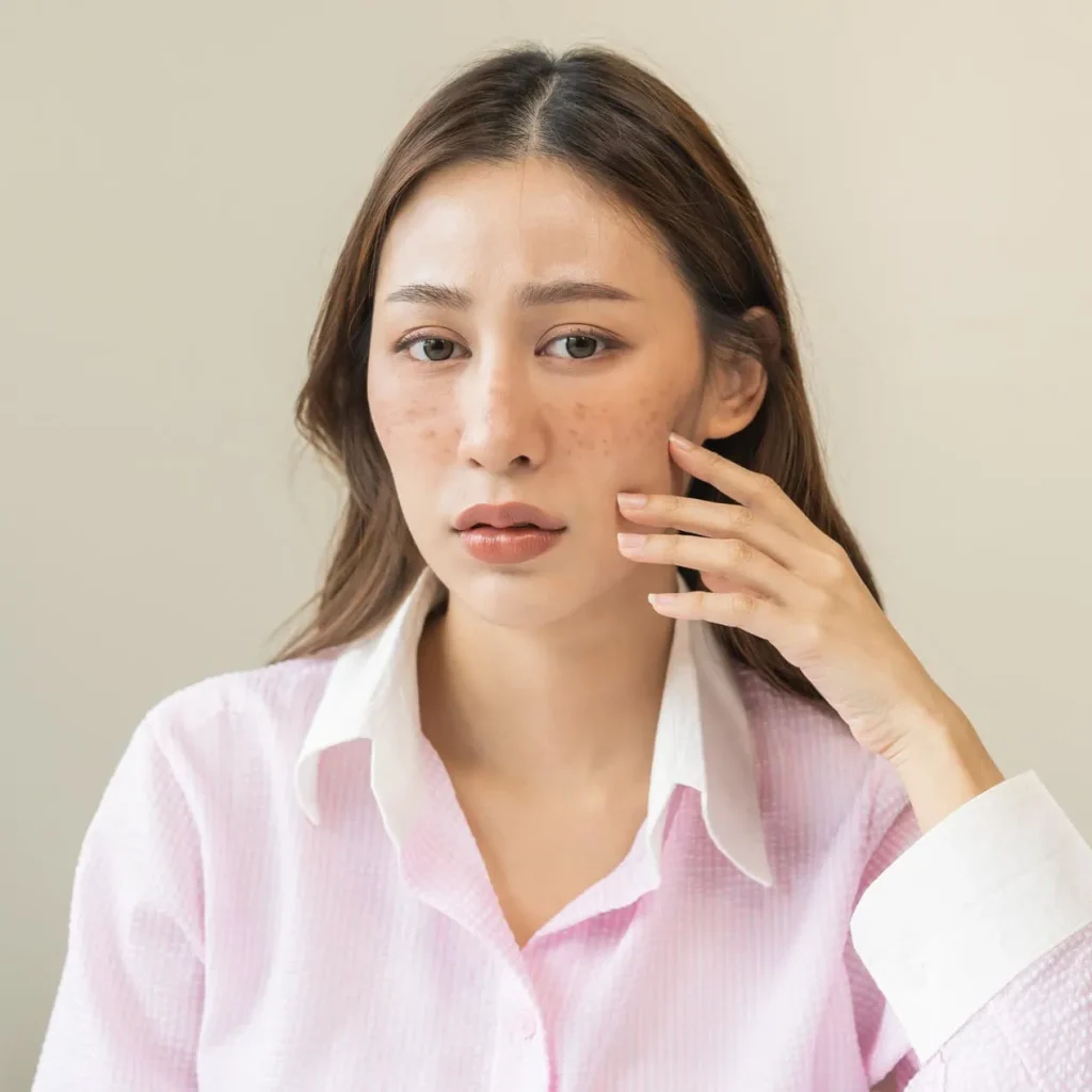 Brown-Spot-Removal-viva-medspa-in-Cranston-RI