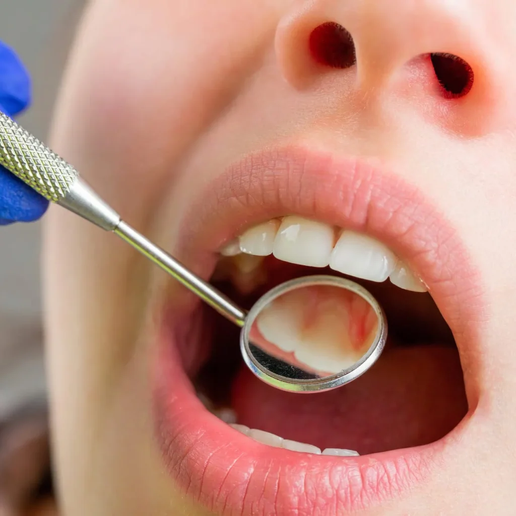 Teeth-Germs-viva-medspa-in-Cranston-RI